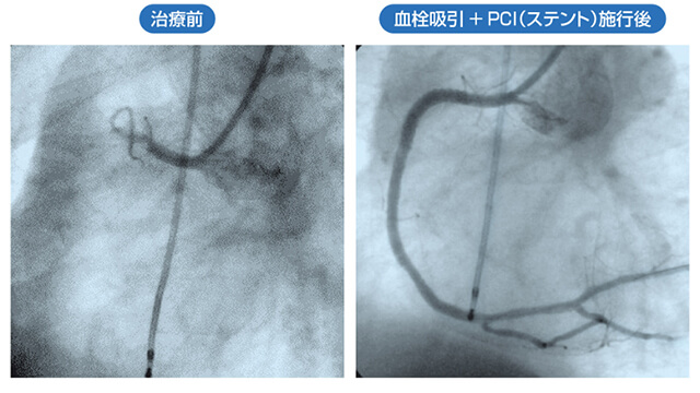 血管の造影画像